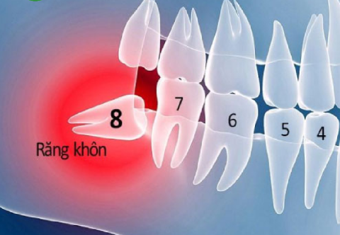 Nhổ Răng Khôn Là Gì? Quy Trình Và Các Lưu Ý Trước, Sau Khi Xử Lý